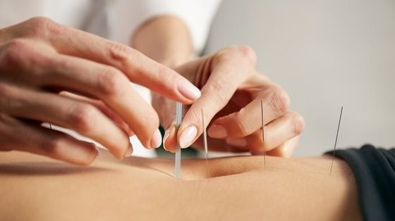 0Aiguilles d'acupuncture intradermique en argent de 16 mm pour soulager la douleur